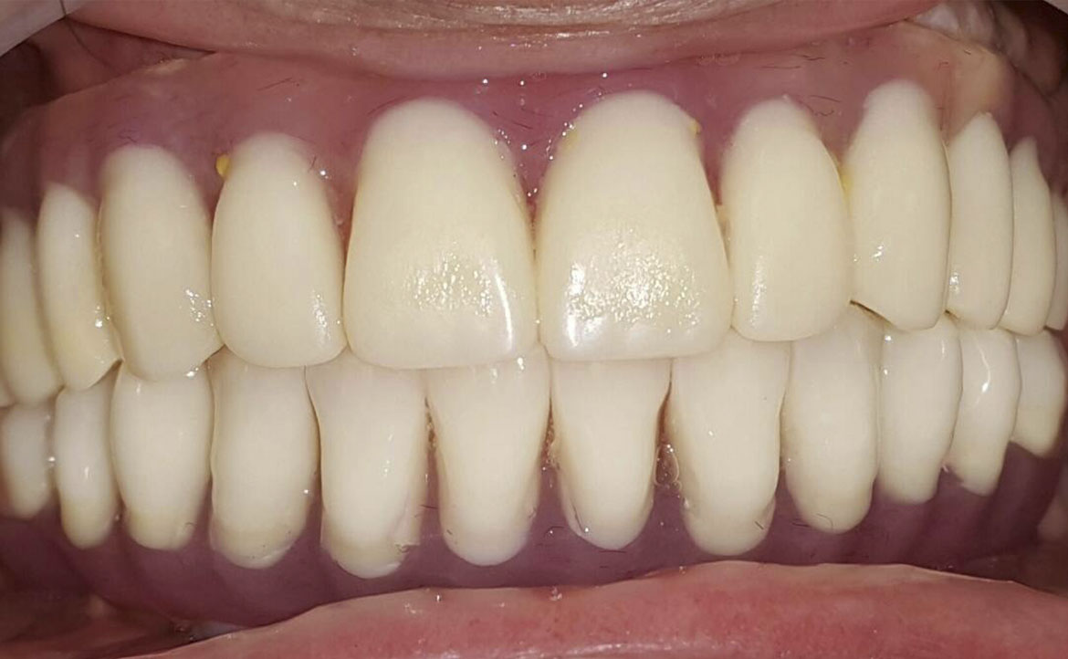 Fast and Fixed teeth after