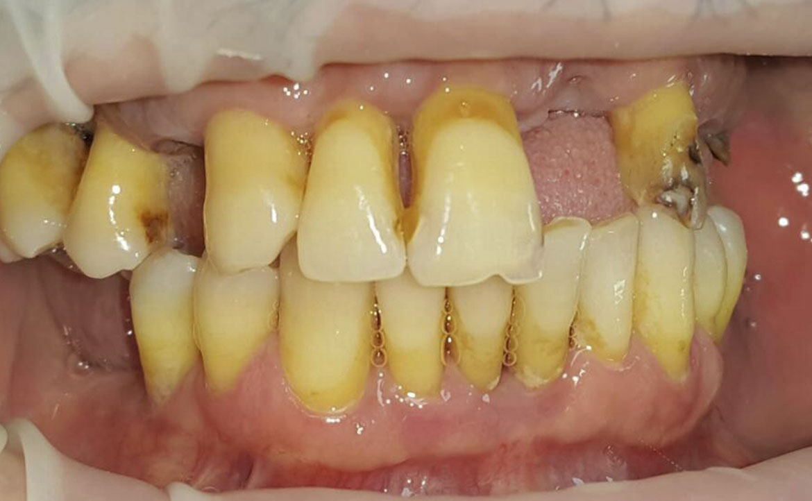 Fast and Fixed teeth before